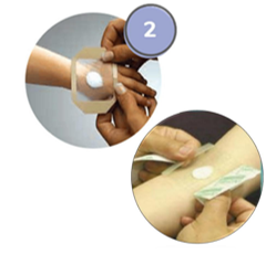 Applying dressing