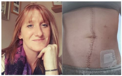 Kelly McKay-Ainsworth and her ovarian cancer scar